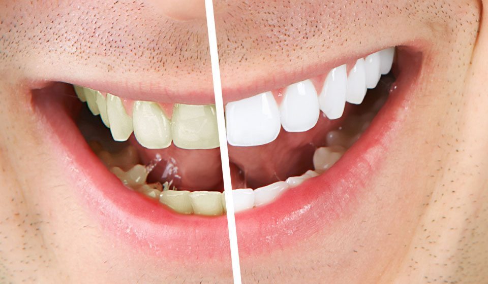 Teeth Whitening Featured Image - Drake Family Dentistry