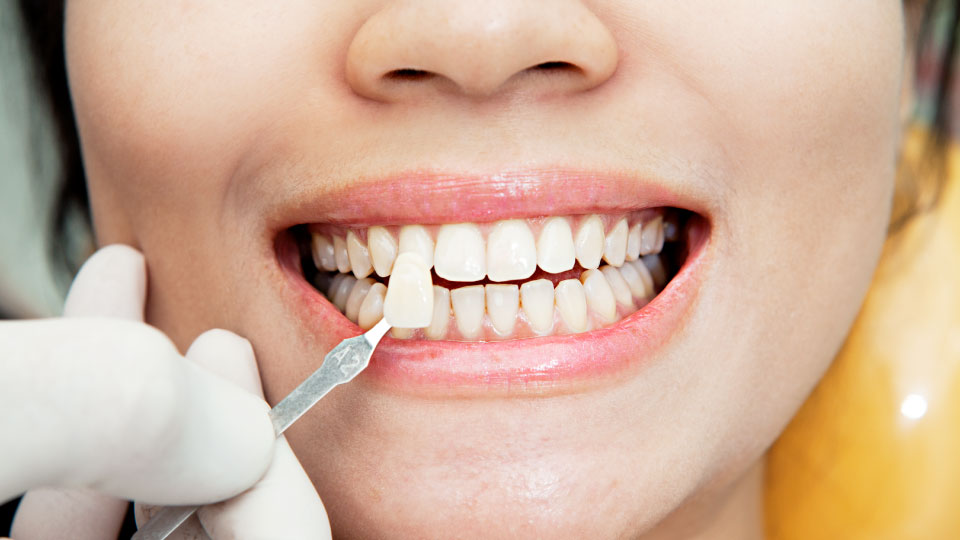 How Long do Veneers Last Featured Image - Drake Family Dentistry