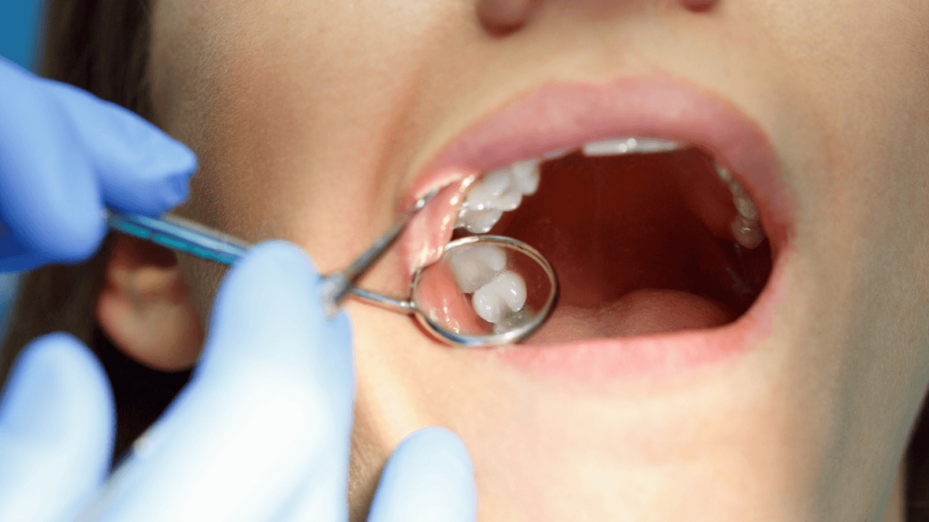 Do Your Dental Fillings Need to Be Replaced Featured Image - Drake Family Dentistry