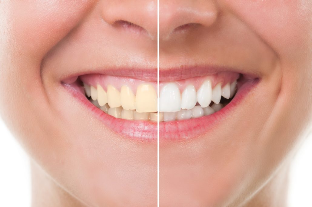 Whitening Special Featured Image - Drake Family Dentistry